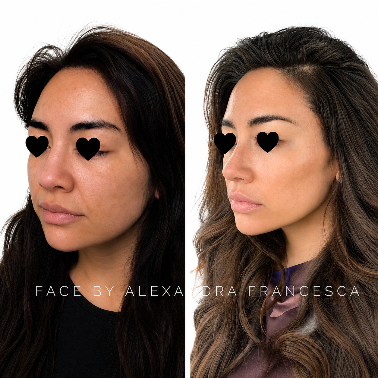 Full Face Filler before and after result