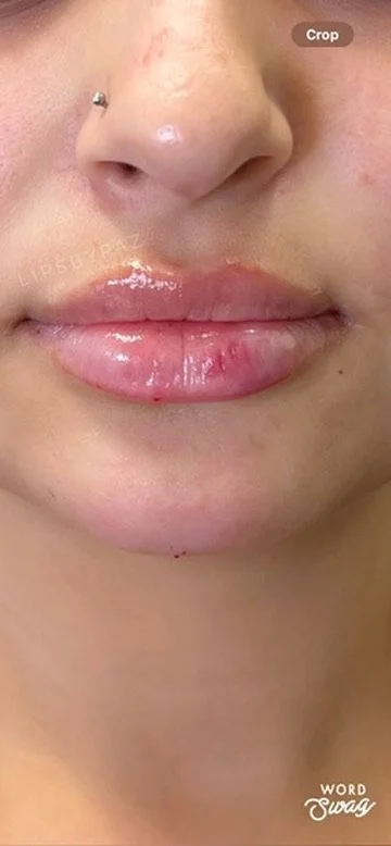 Lip Filler before and after result