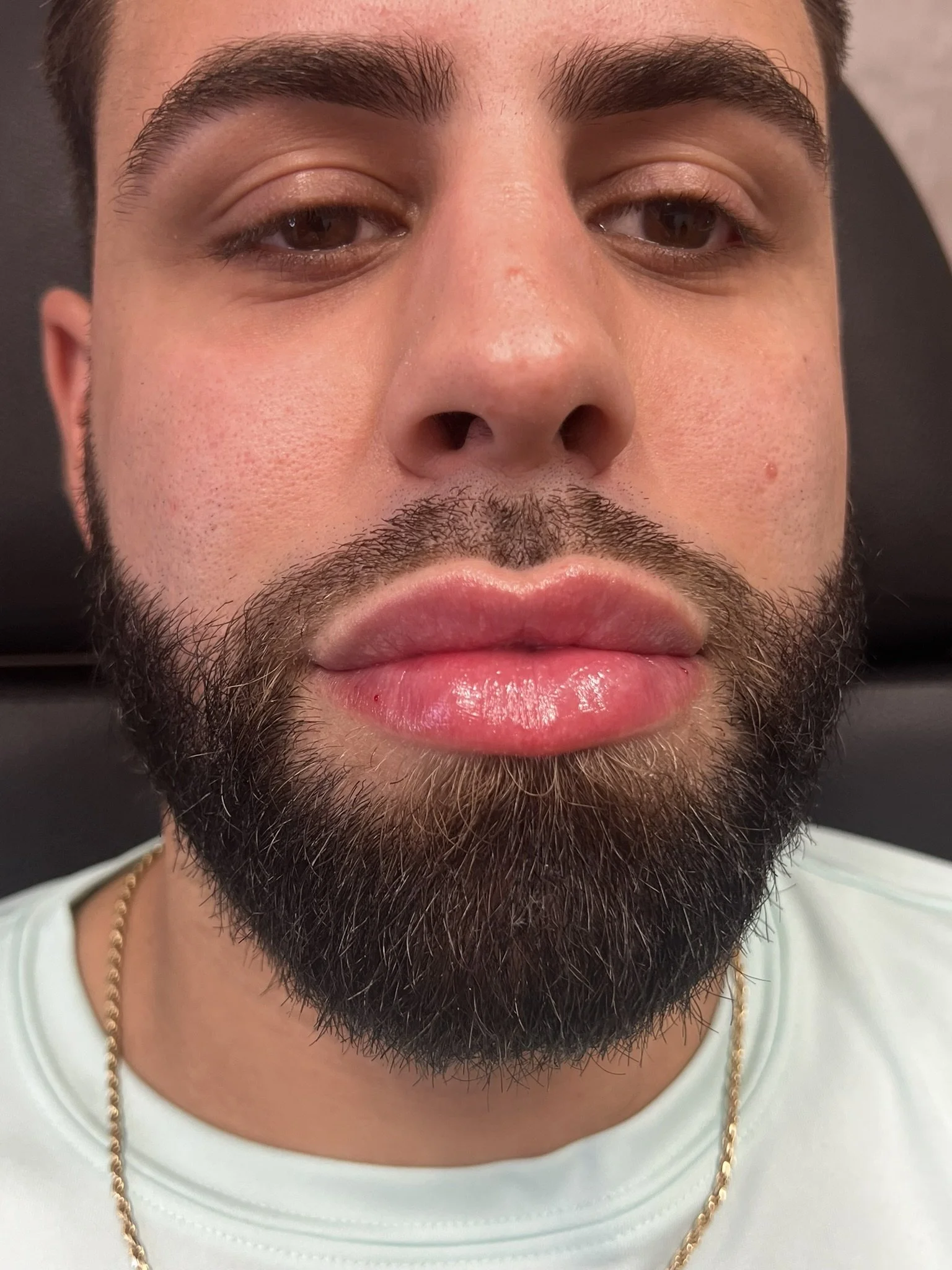 Lip Filler before and after result