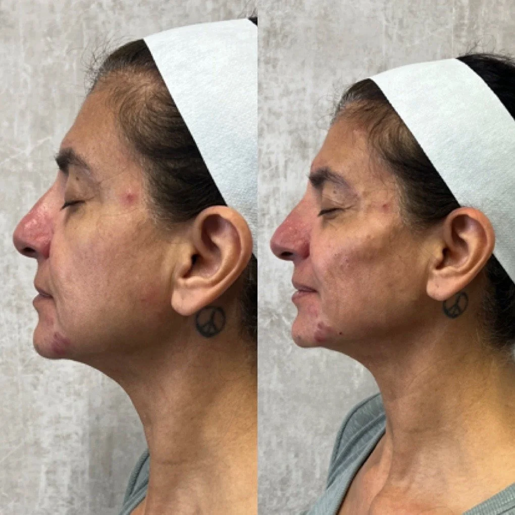 Cheek Filler before and after result