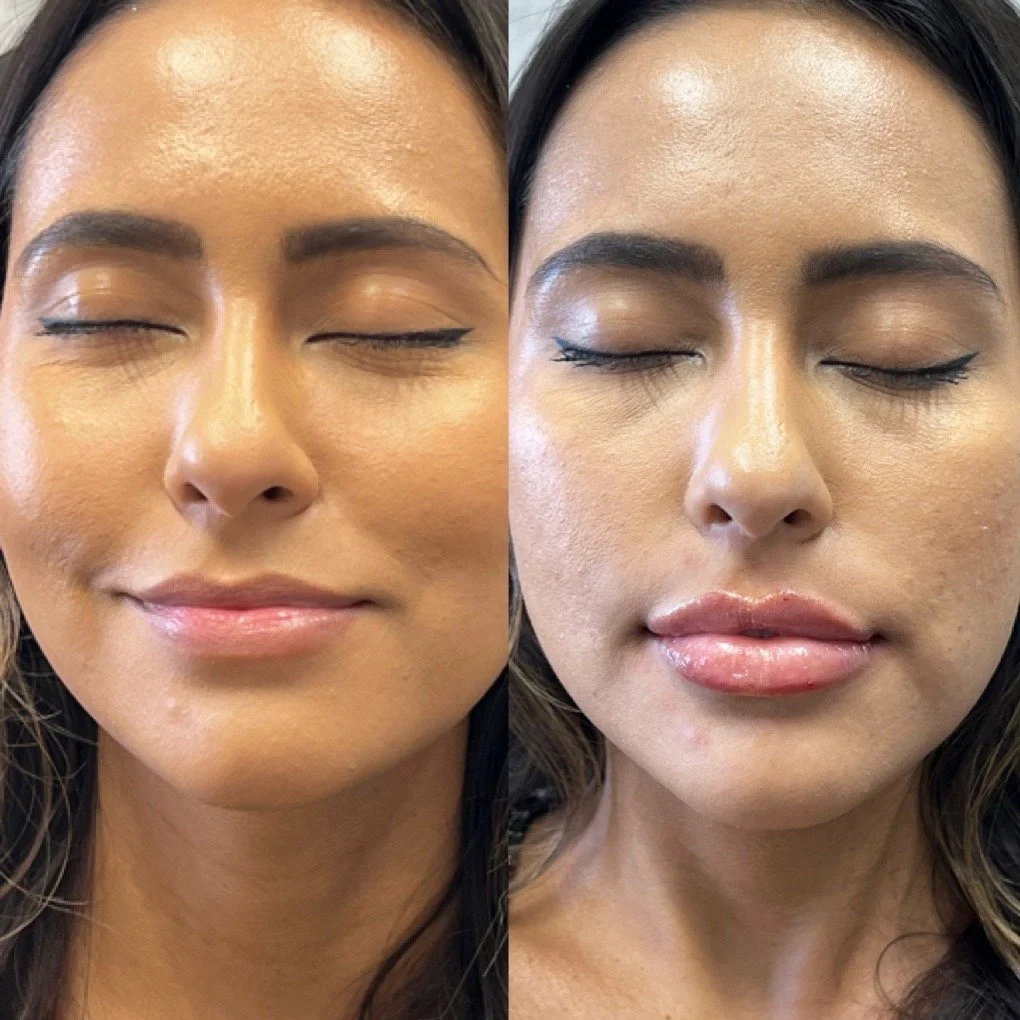 Lip Filler before and after result