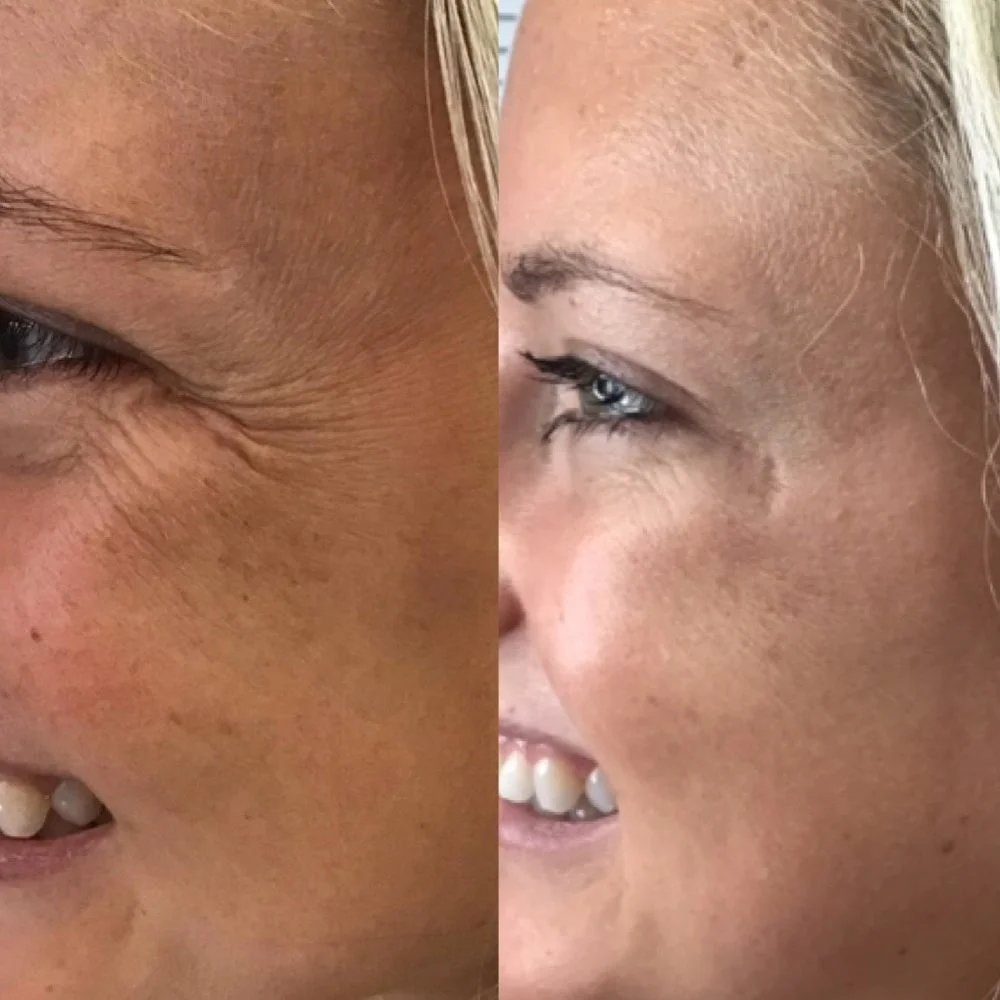 Botox before and after result