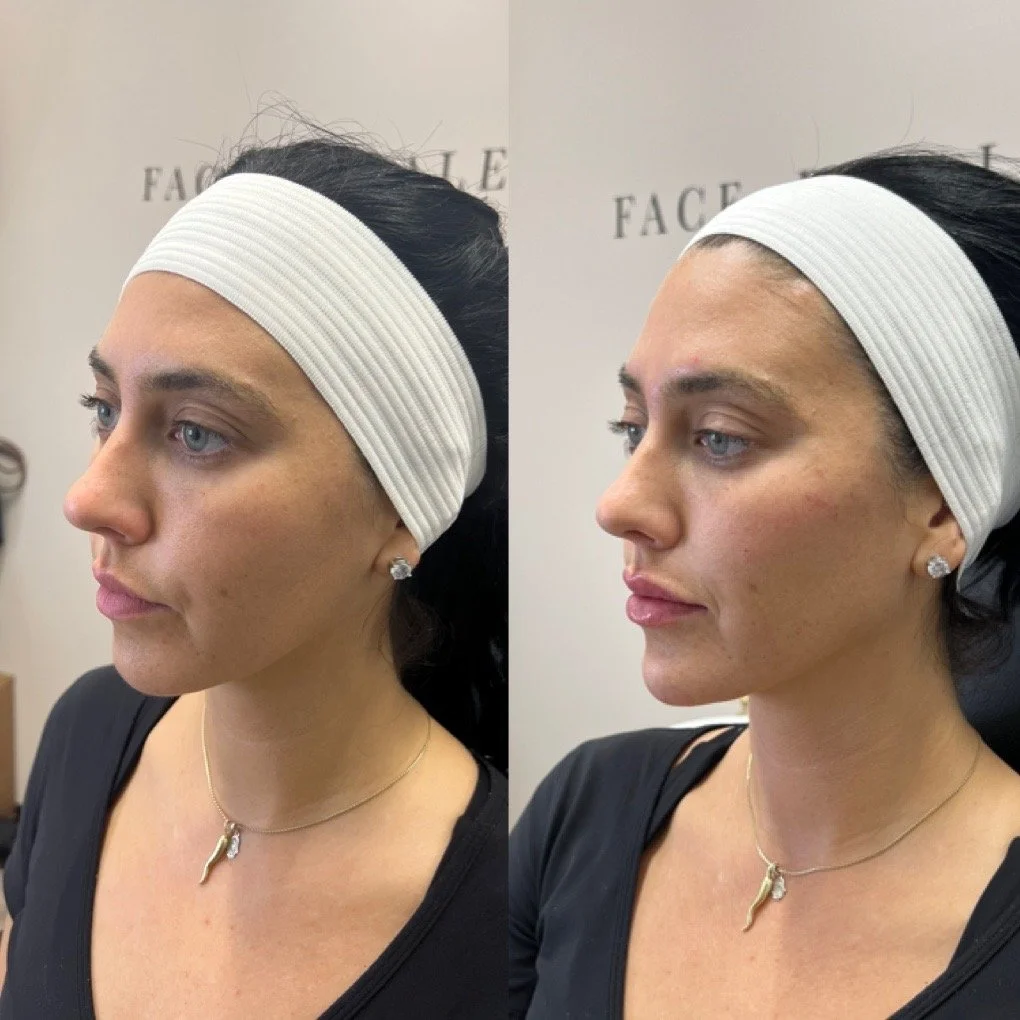 Full Face Filler before and after result