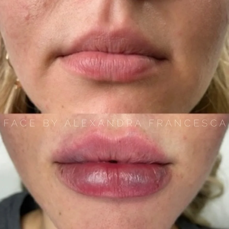 Lip Filler before and after result