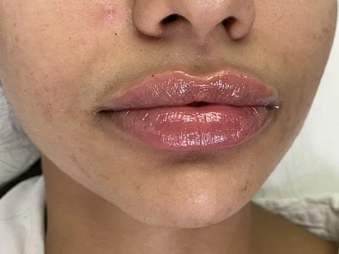 Lip Filler before and after result