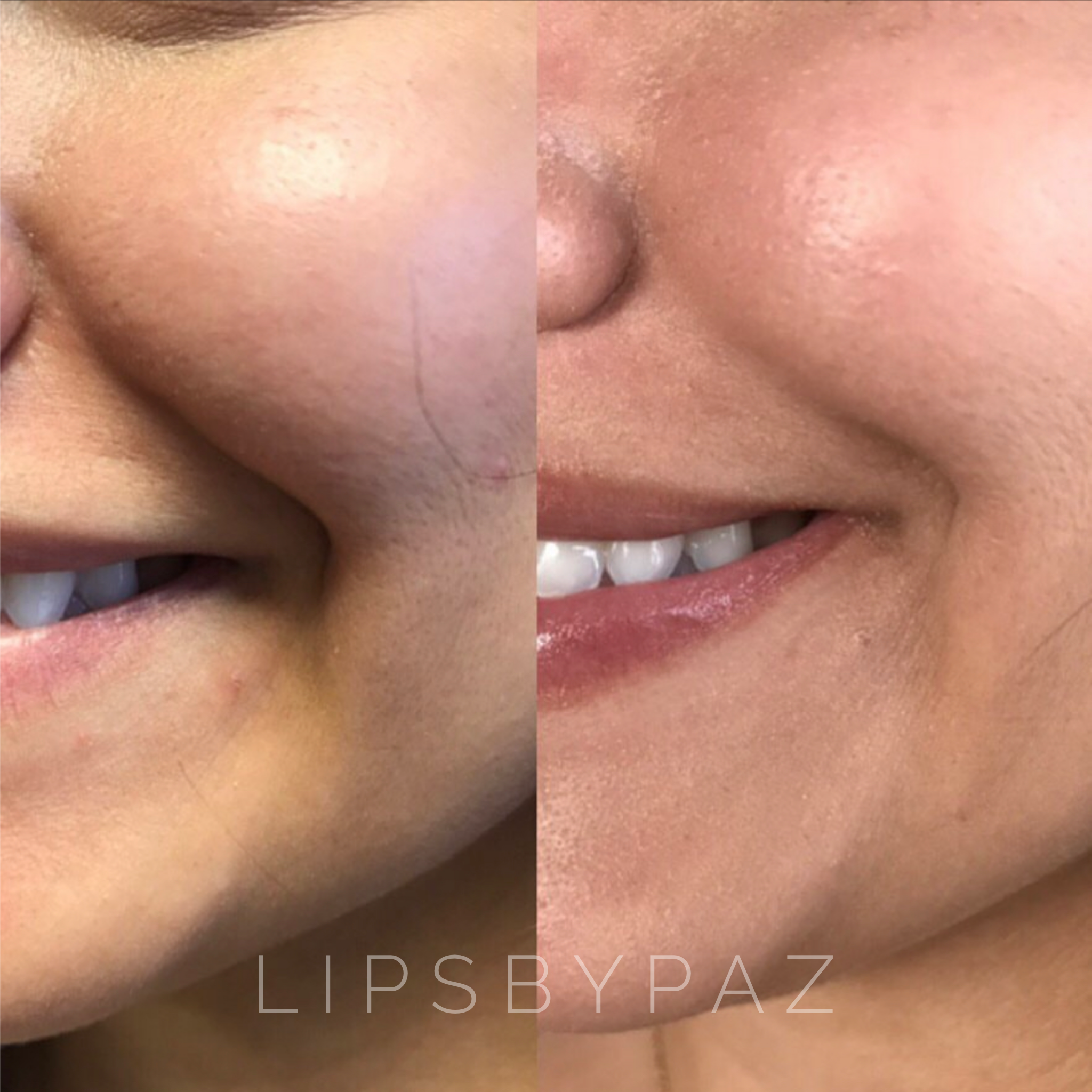 PRF / EZ Gel before and after result