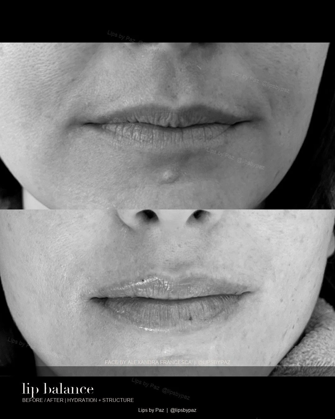 Lip Filler before and after result