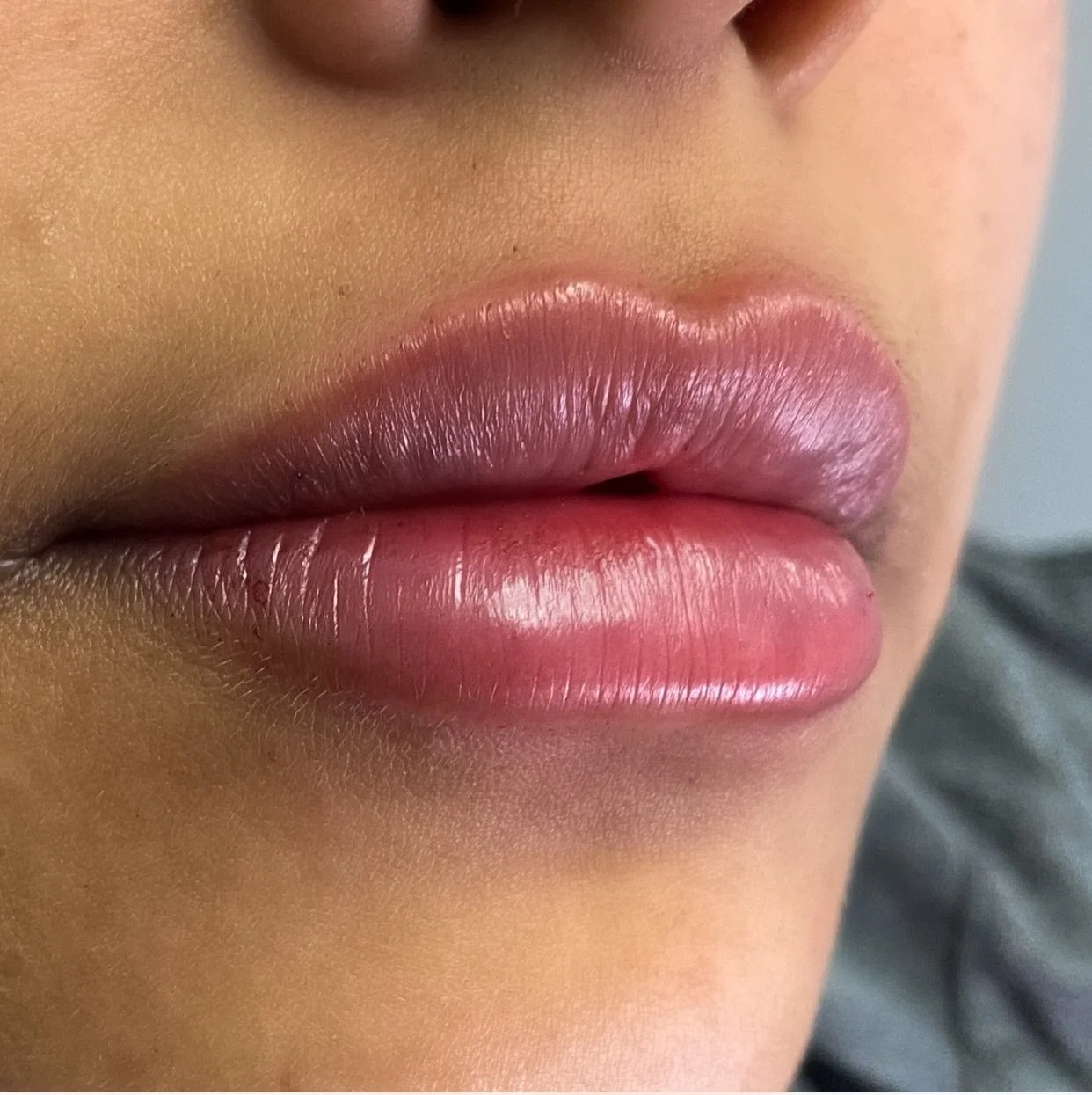 Lip Filler before and after result