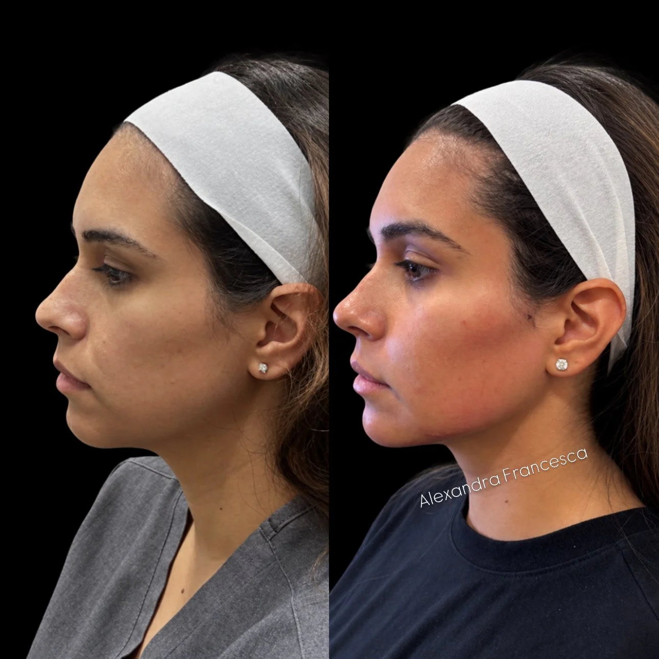 Full Face Filler before and after result