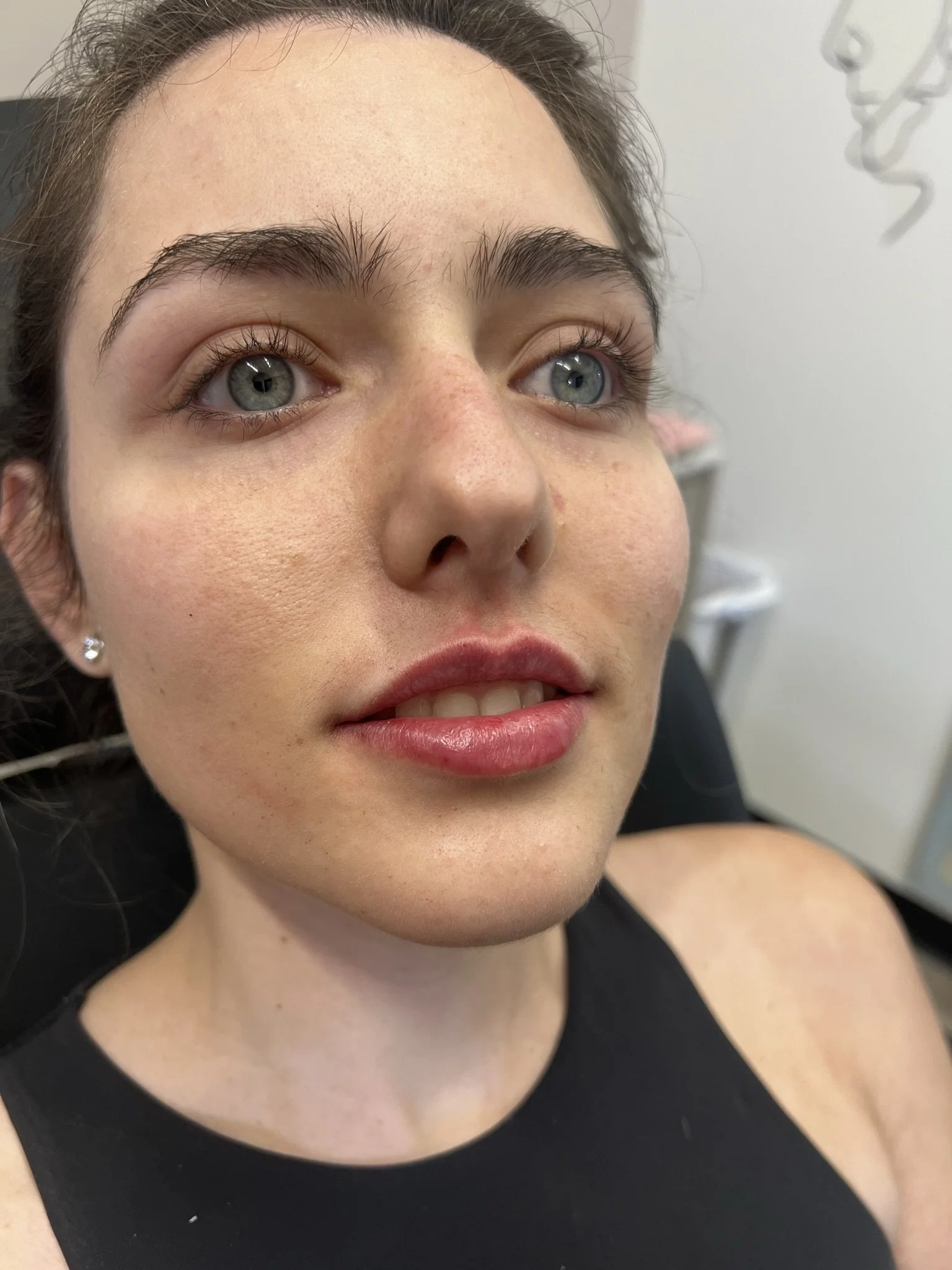 Lip Filler before and after result