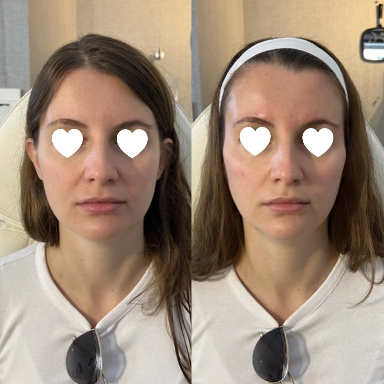 Cheek Filler before and after result