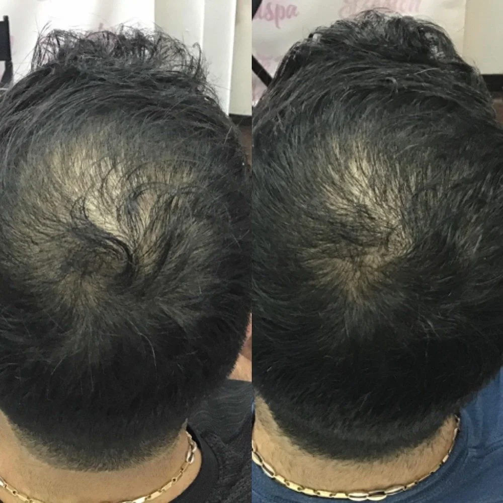 Hair Growth PRF before and after result