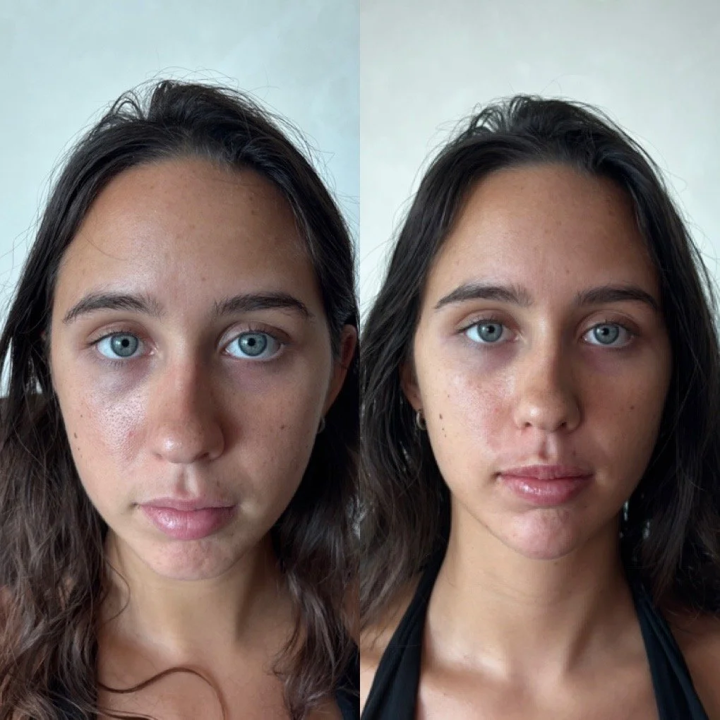 Chin Filler before and after result