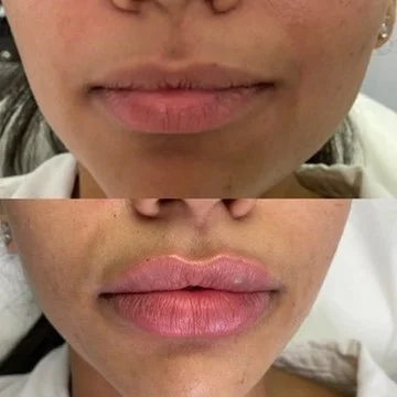 Lip Filler before and after result