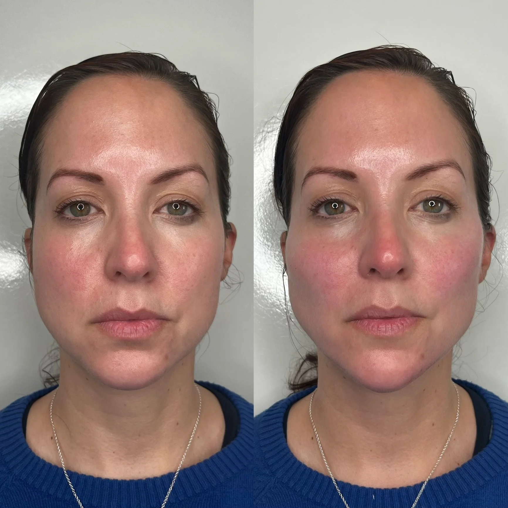 Cheek Filler before and after result