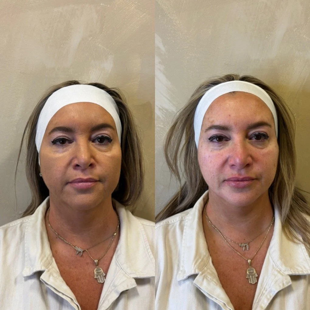 Full Face Filler before and after result