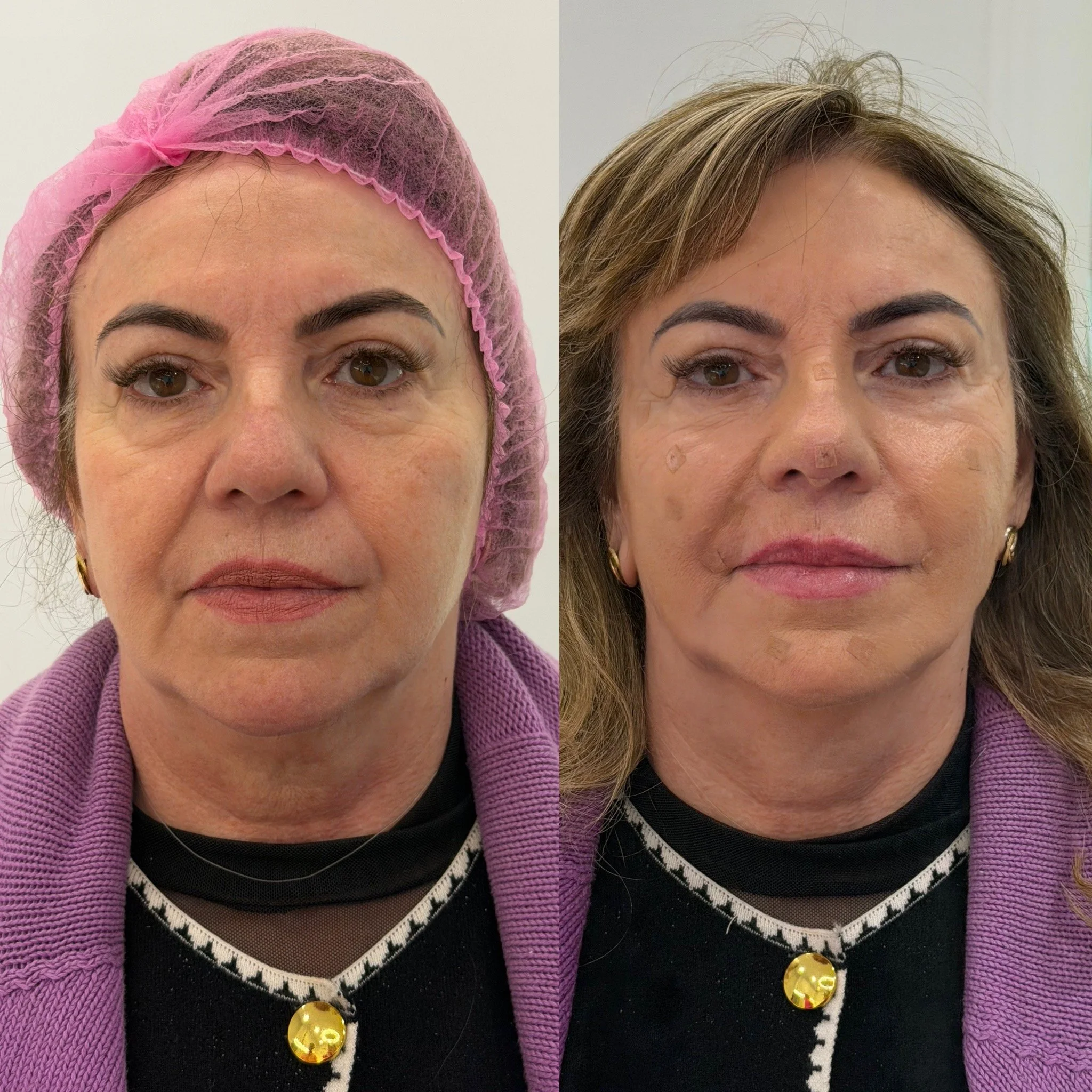 Full Face Filler before and after result