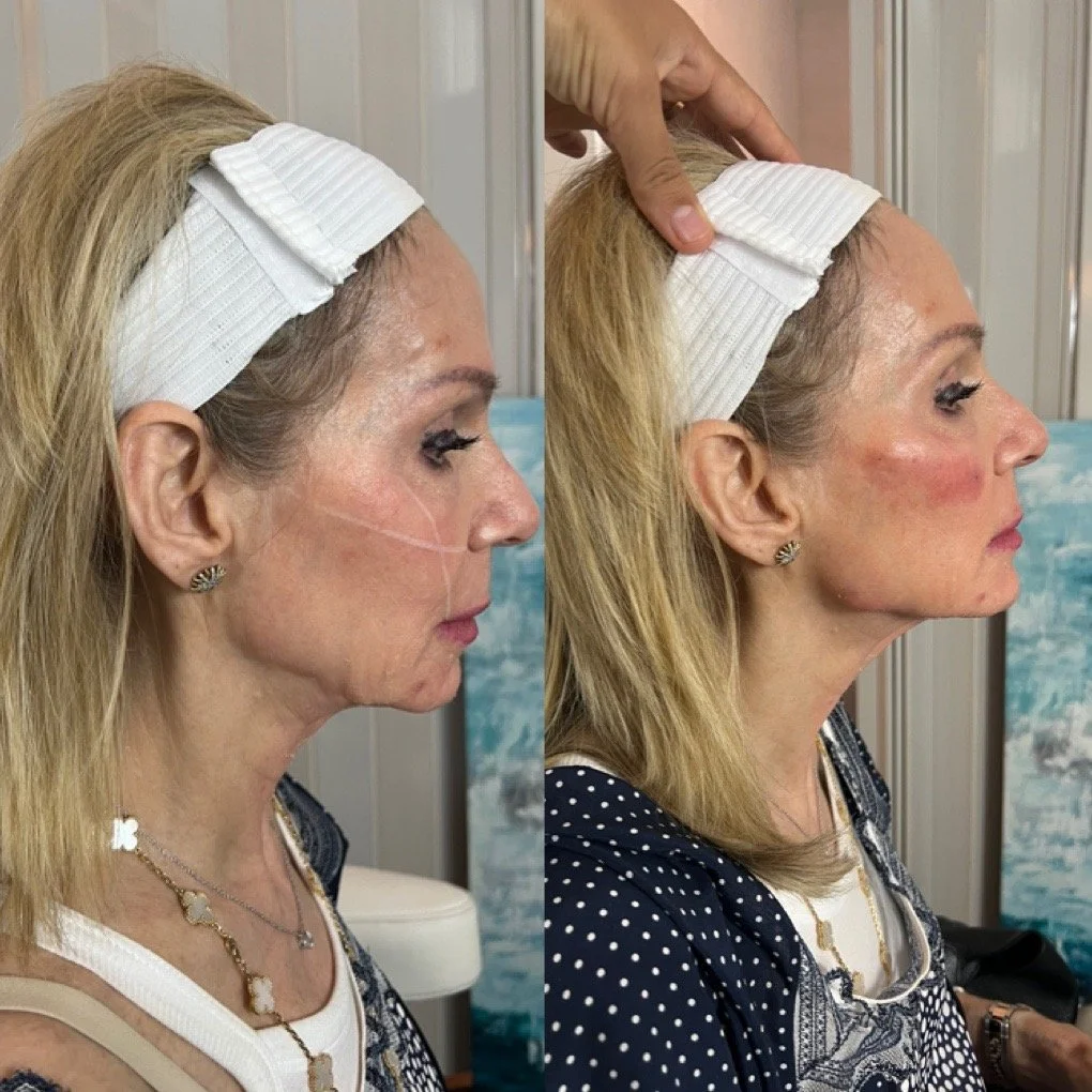 Full Face Filler before and after result