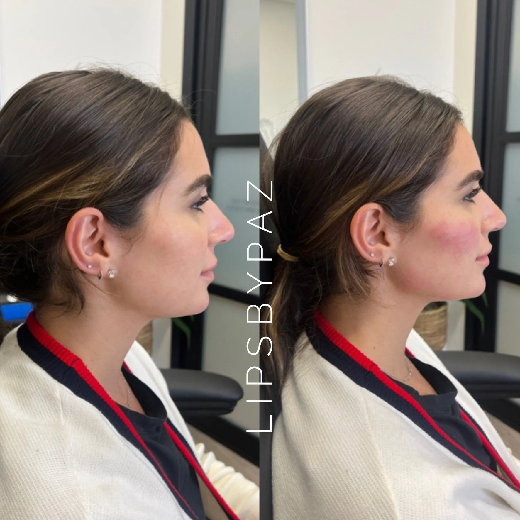 Chin Filler before and after result