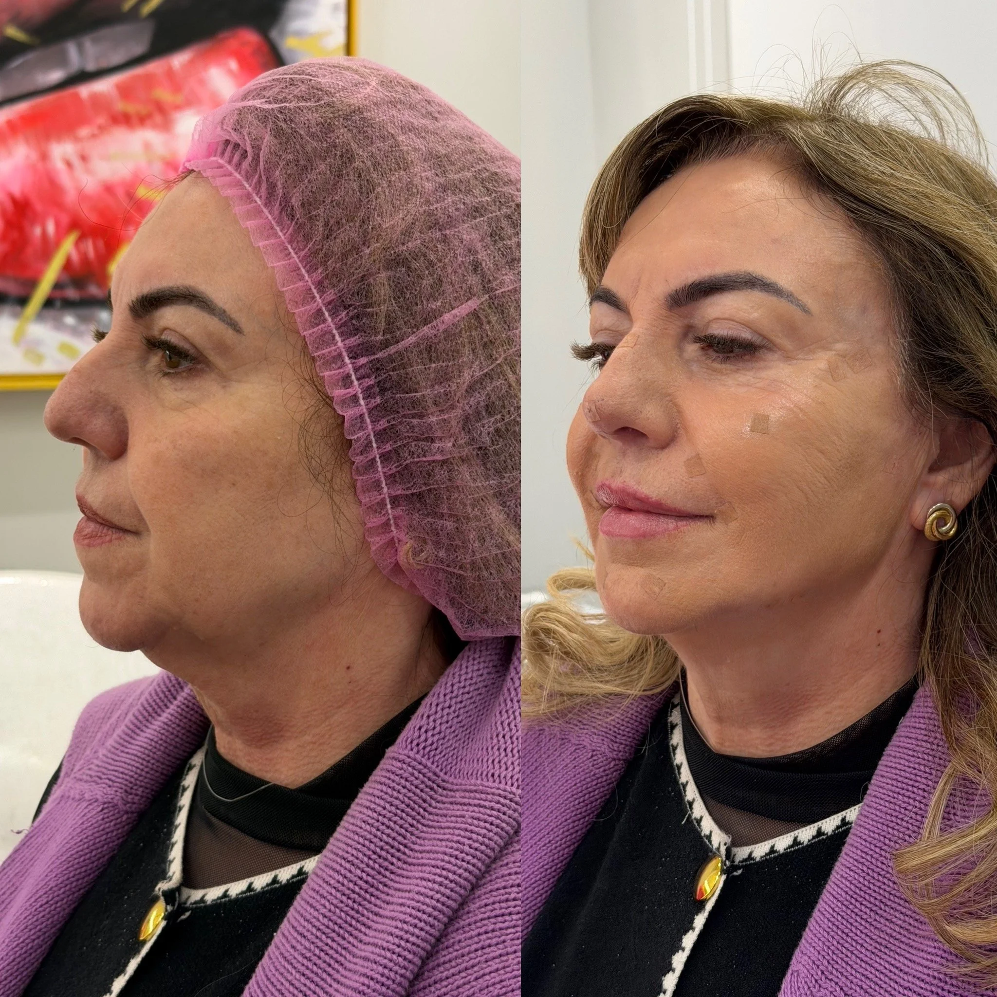 Full Face Filler before and after result