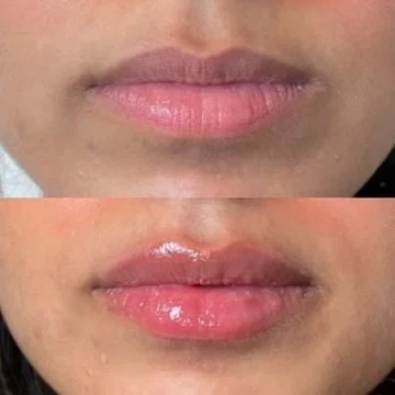 Lip Filler before and after result