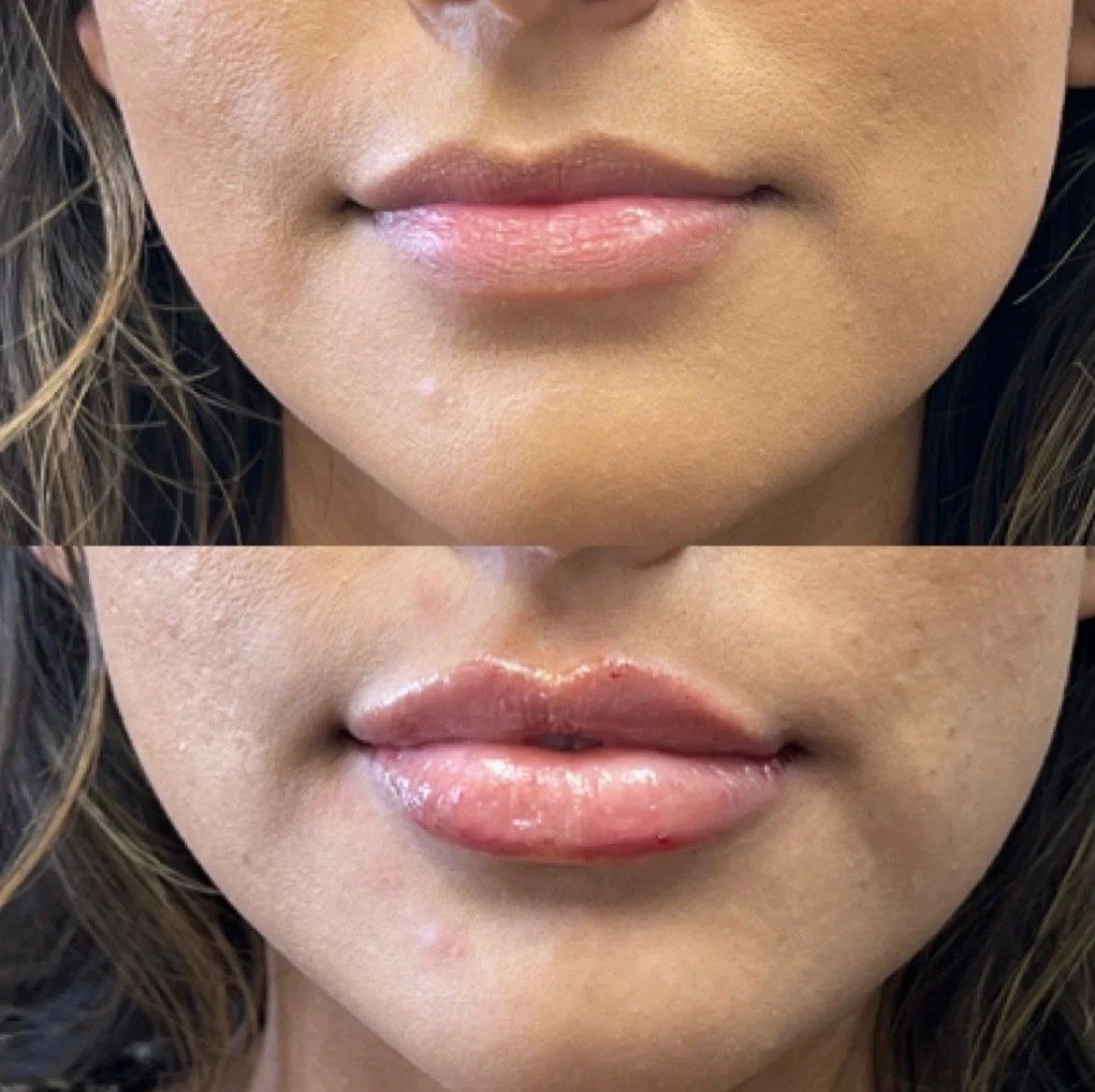 Lip Filler before and after result