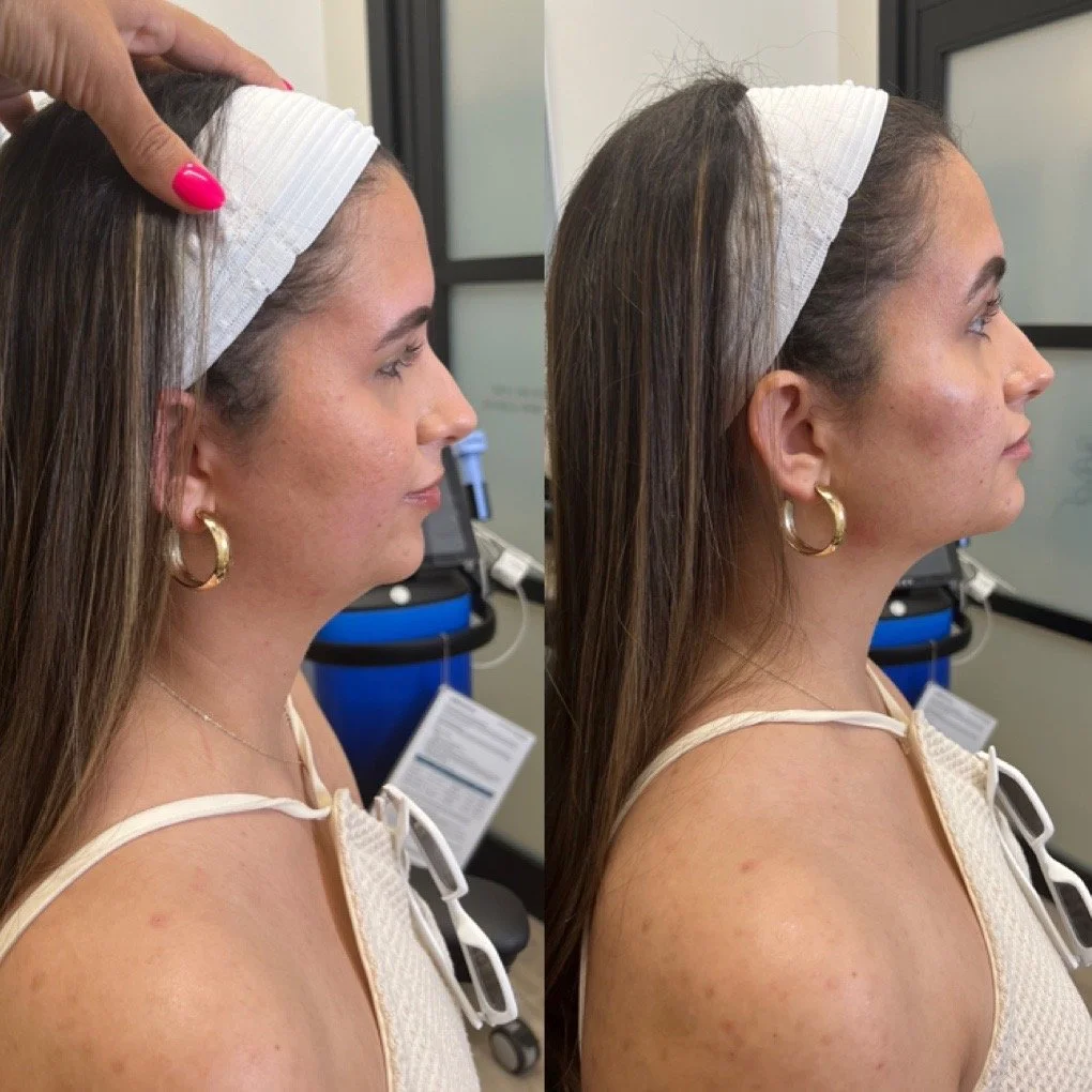 Full Face Filler before and after result