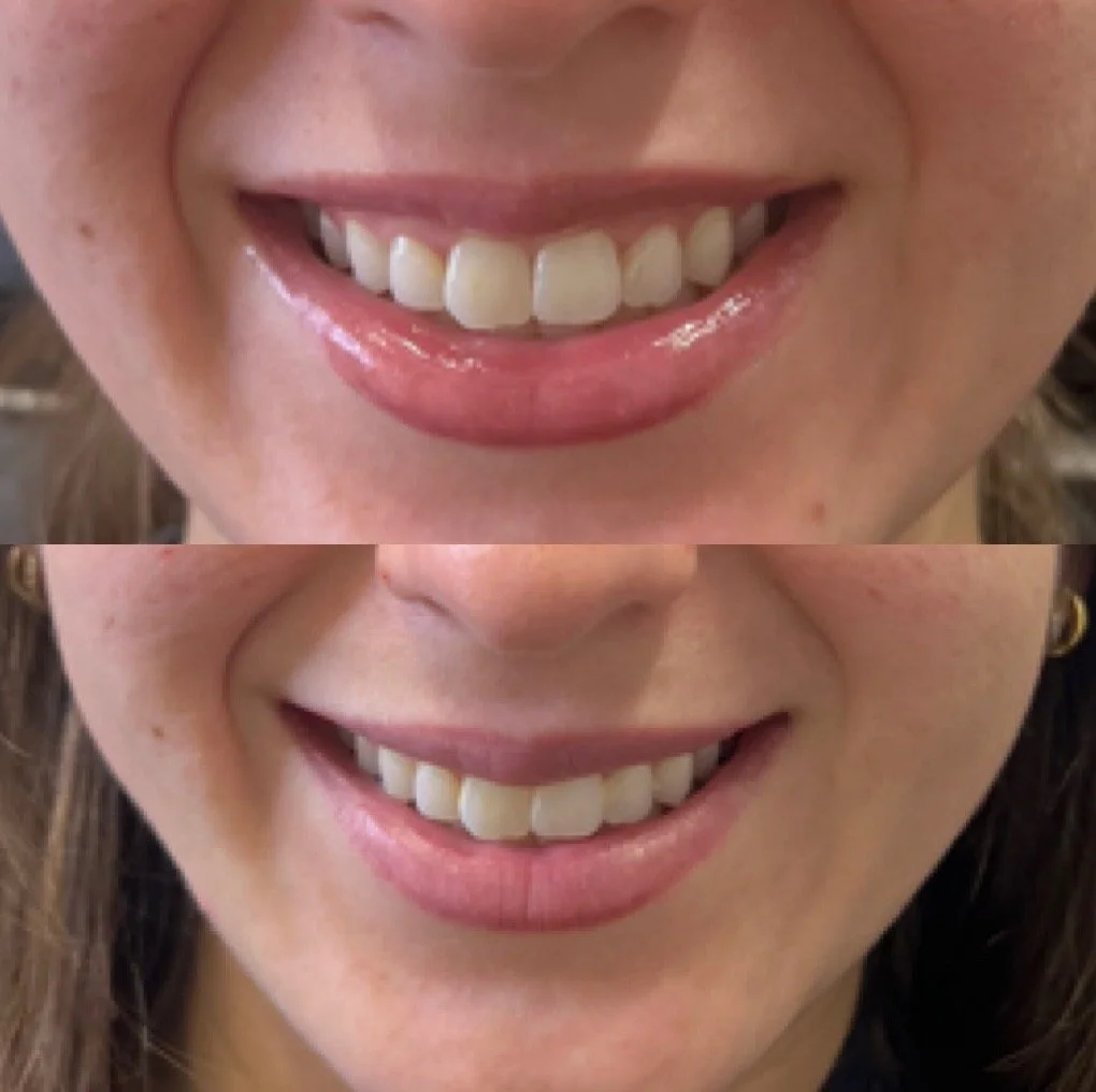Botox Lip Flip before and after result