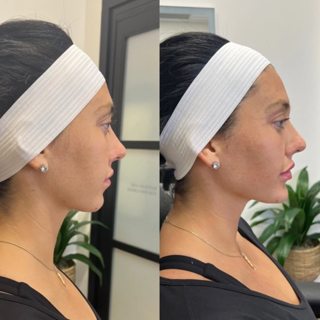 Chin Filler before and after result