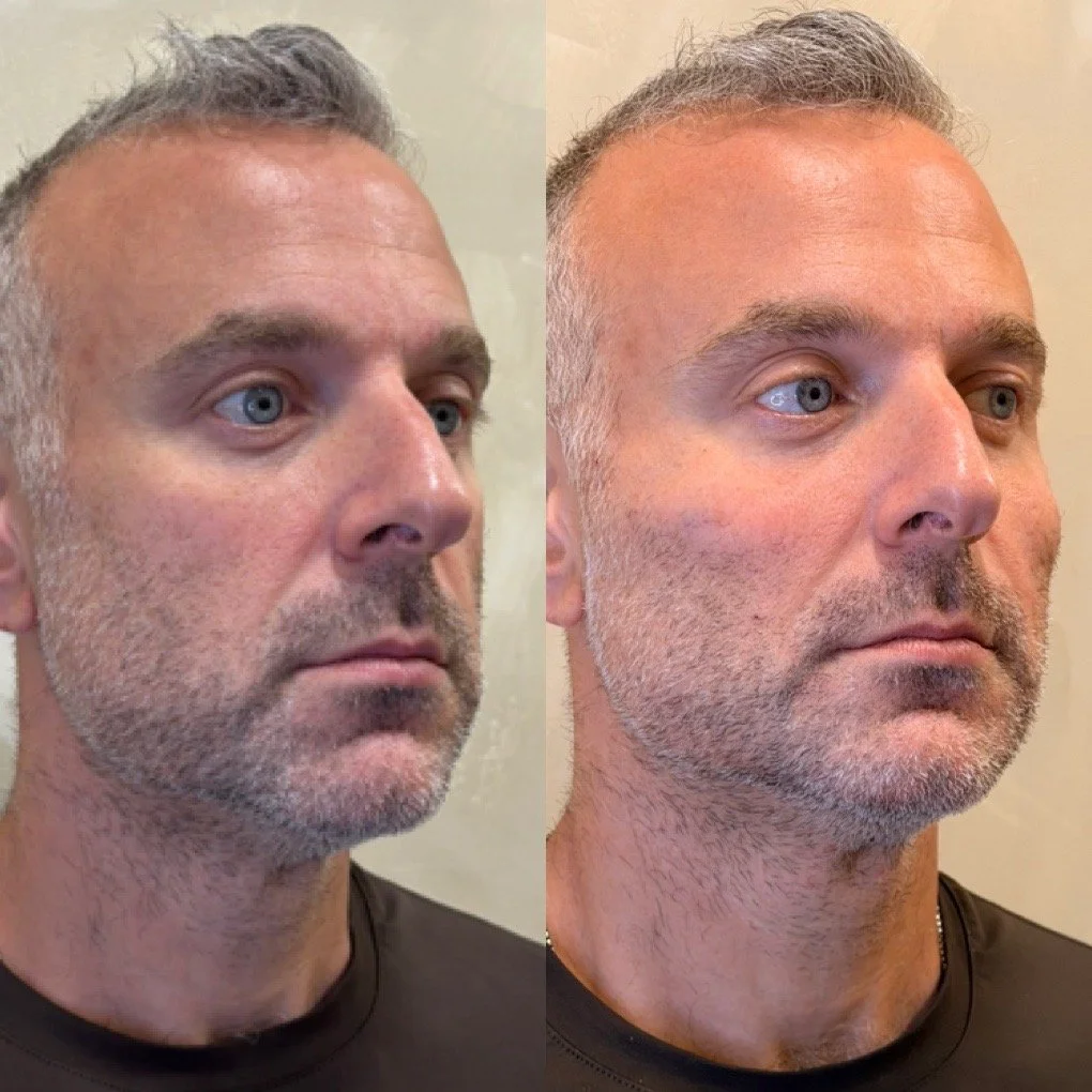 Full Face Filler before and after result