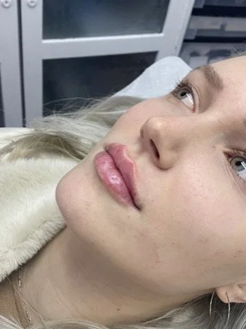 Lip Filler before and after result