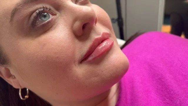 Lip Filler before and after result
