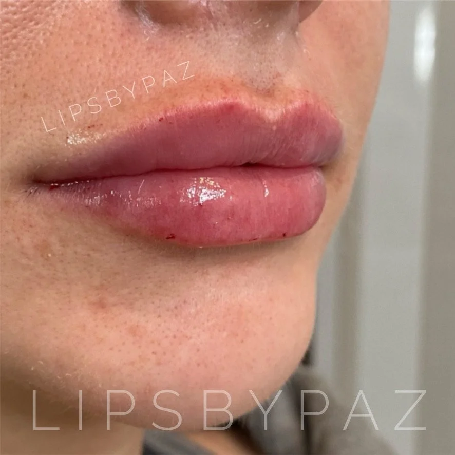 Lip Filler before and after result