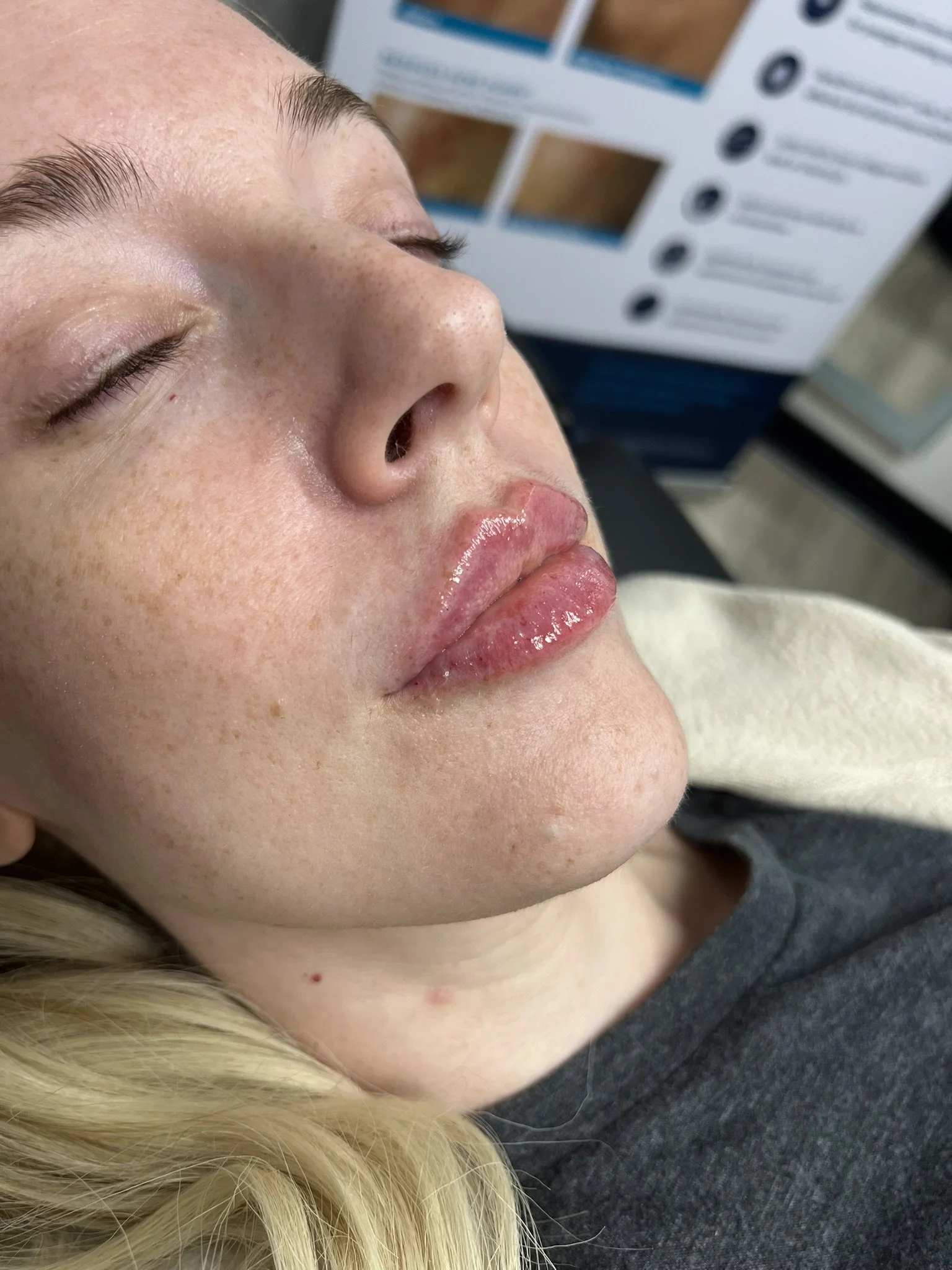 Lip Filler before and after result