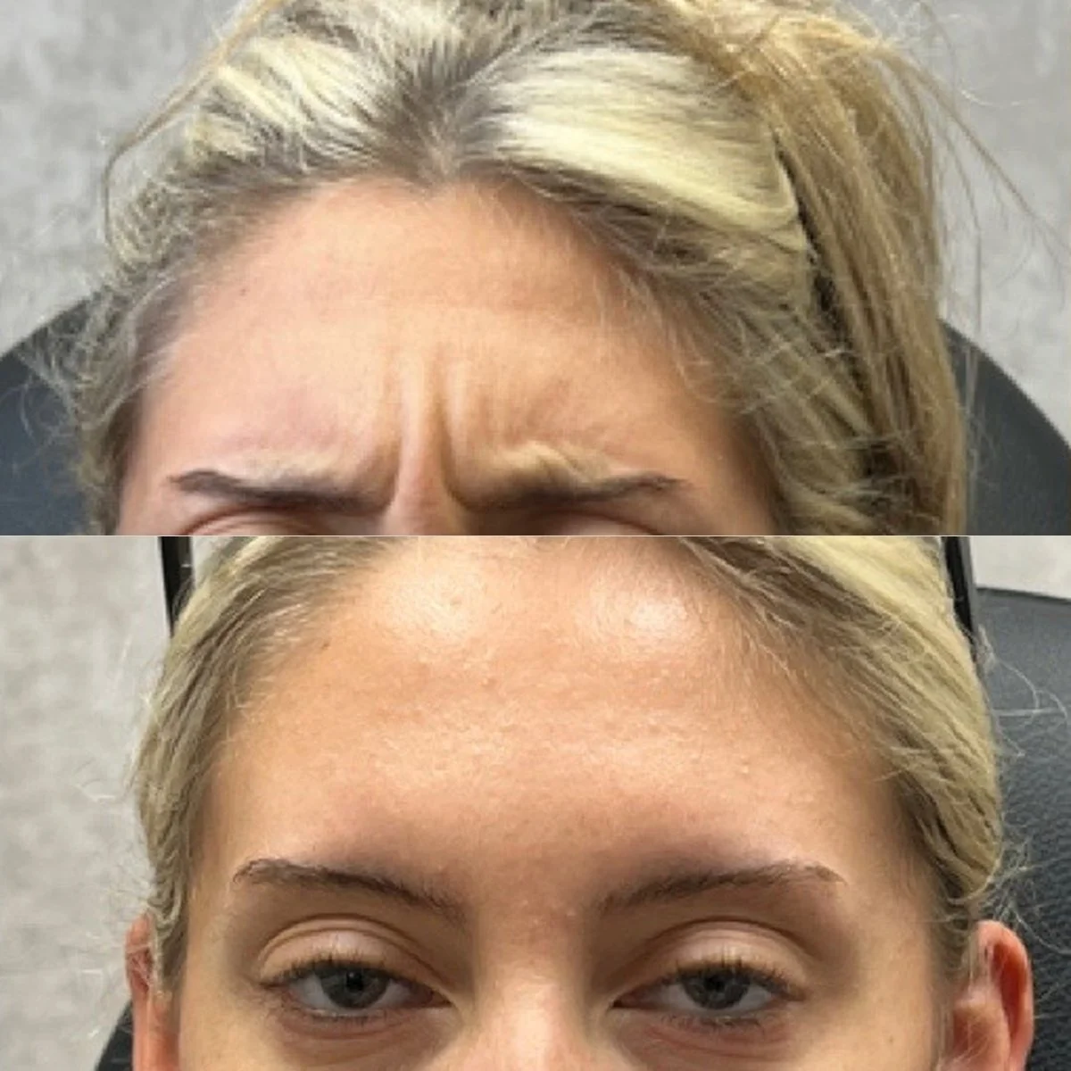 Botox before and after result