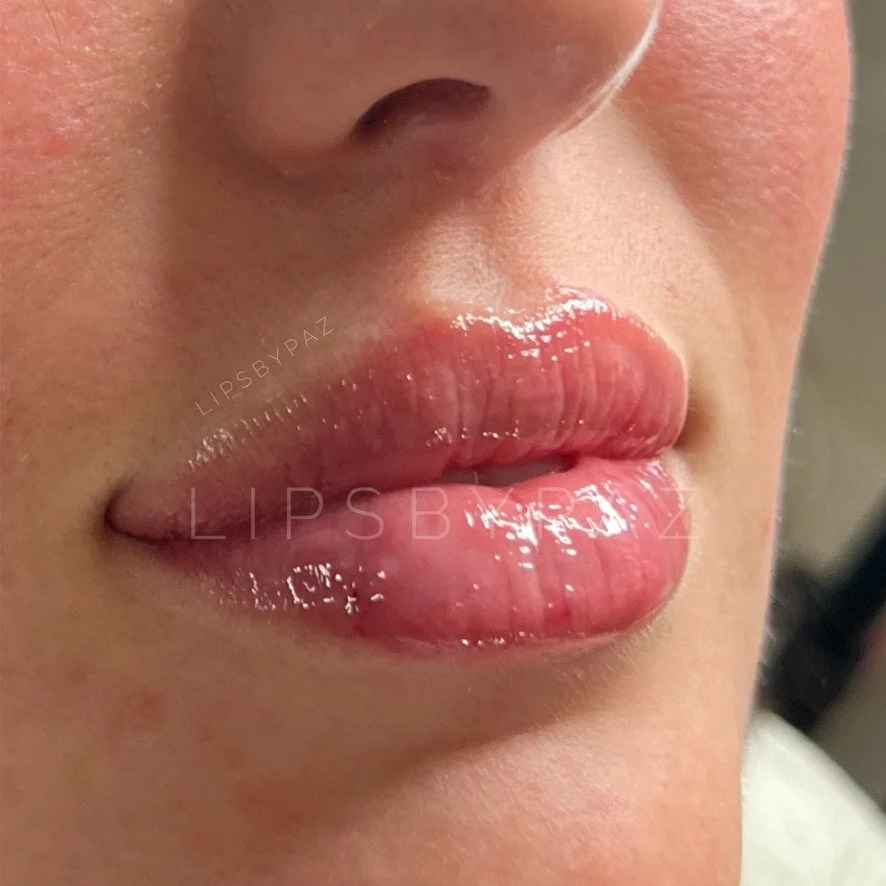 Lip Filler before and after result