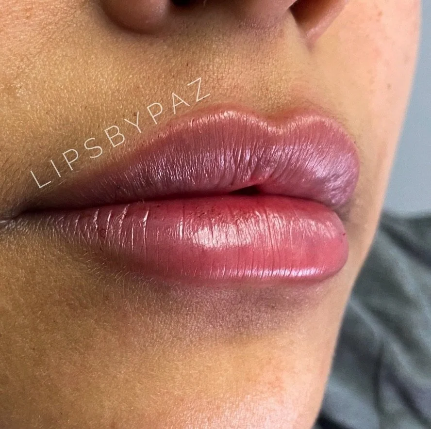 Lip Filler before and after result