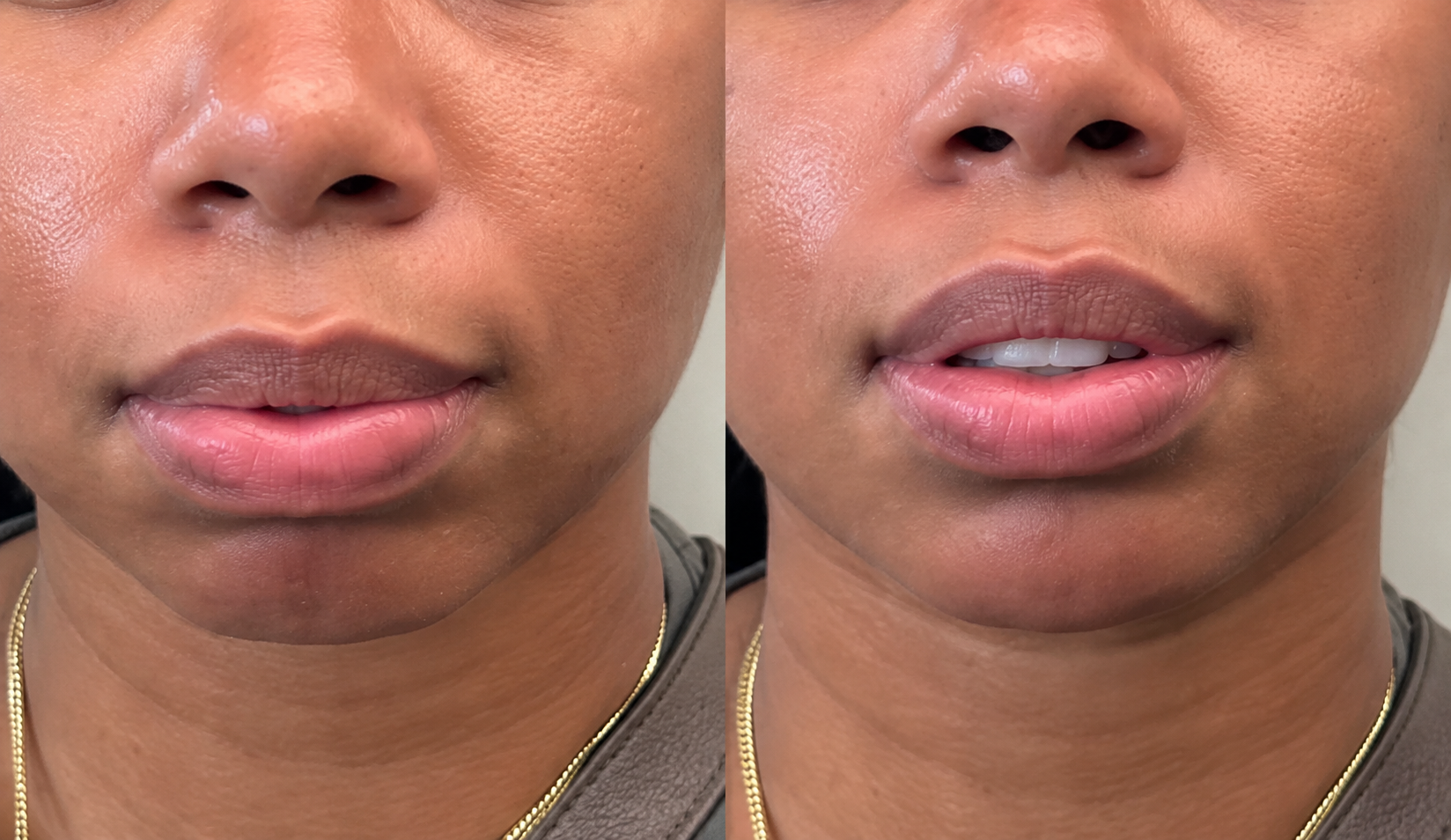 Chin Filler before and after result