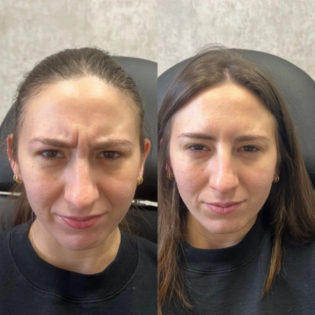 Botox before and after result
