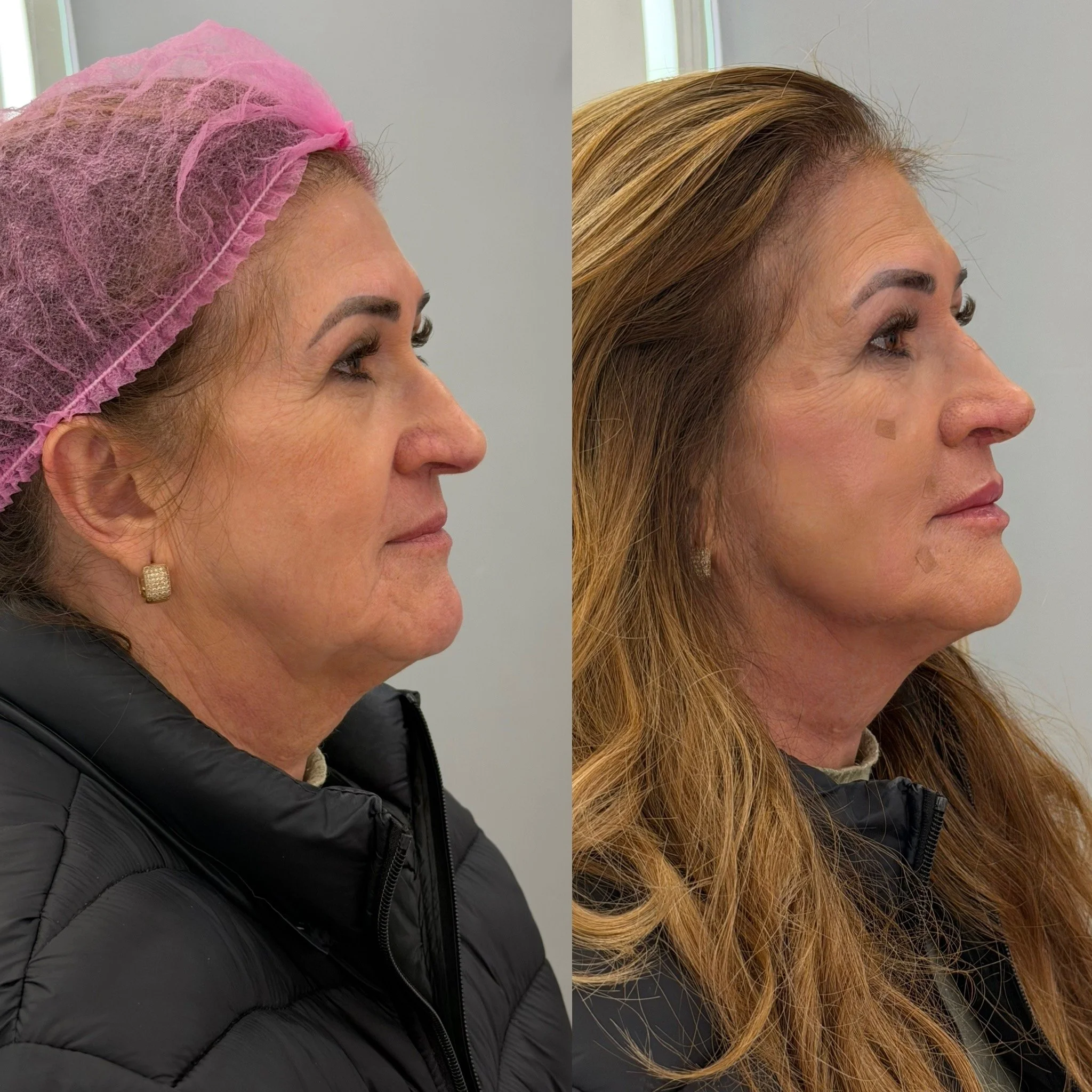 Full Face Filler before and after result