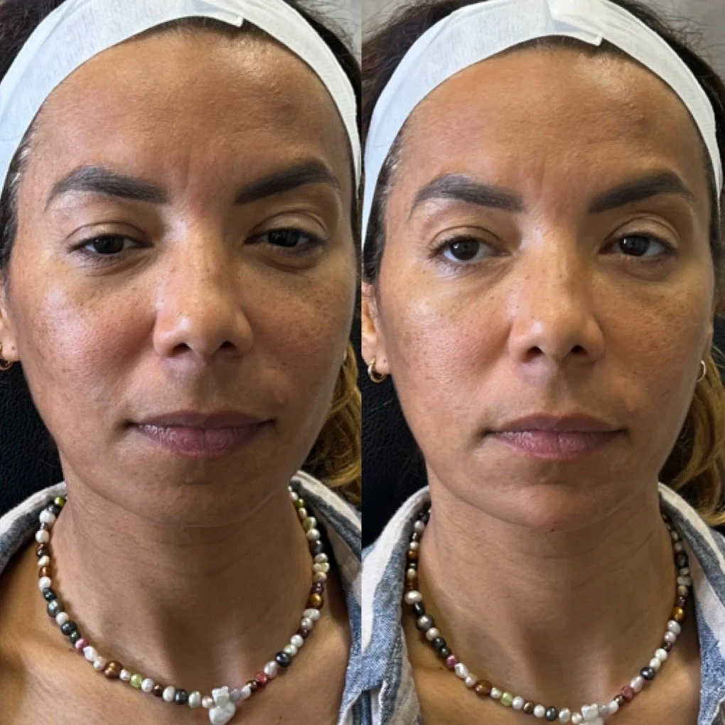 Chin Filler before and after result