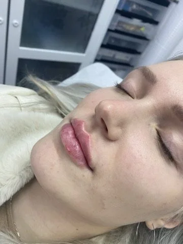Lip Filler before and after result
