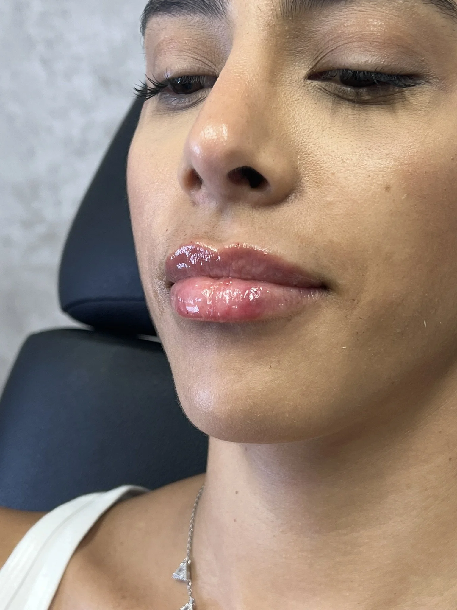 Lip Filler before and after result