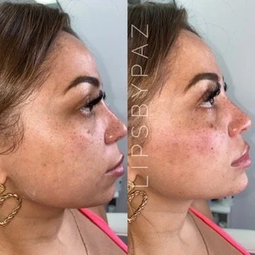 Chin Filler before and after result