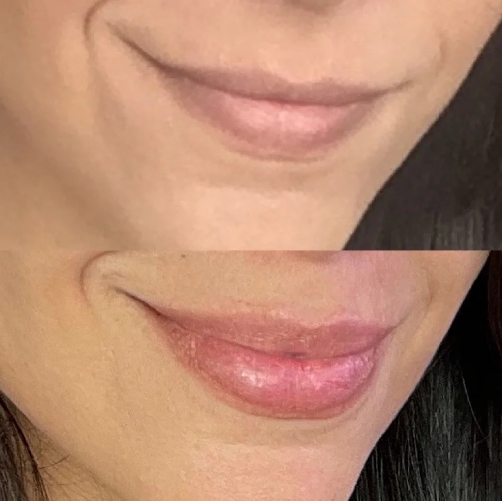 Lip Filler before and after result