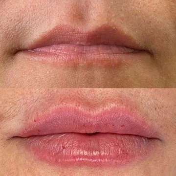 Lip Filler before and after result