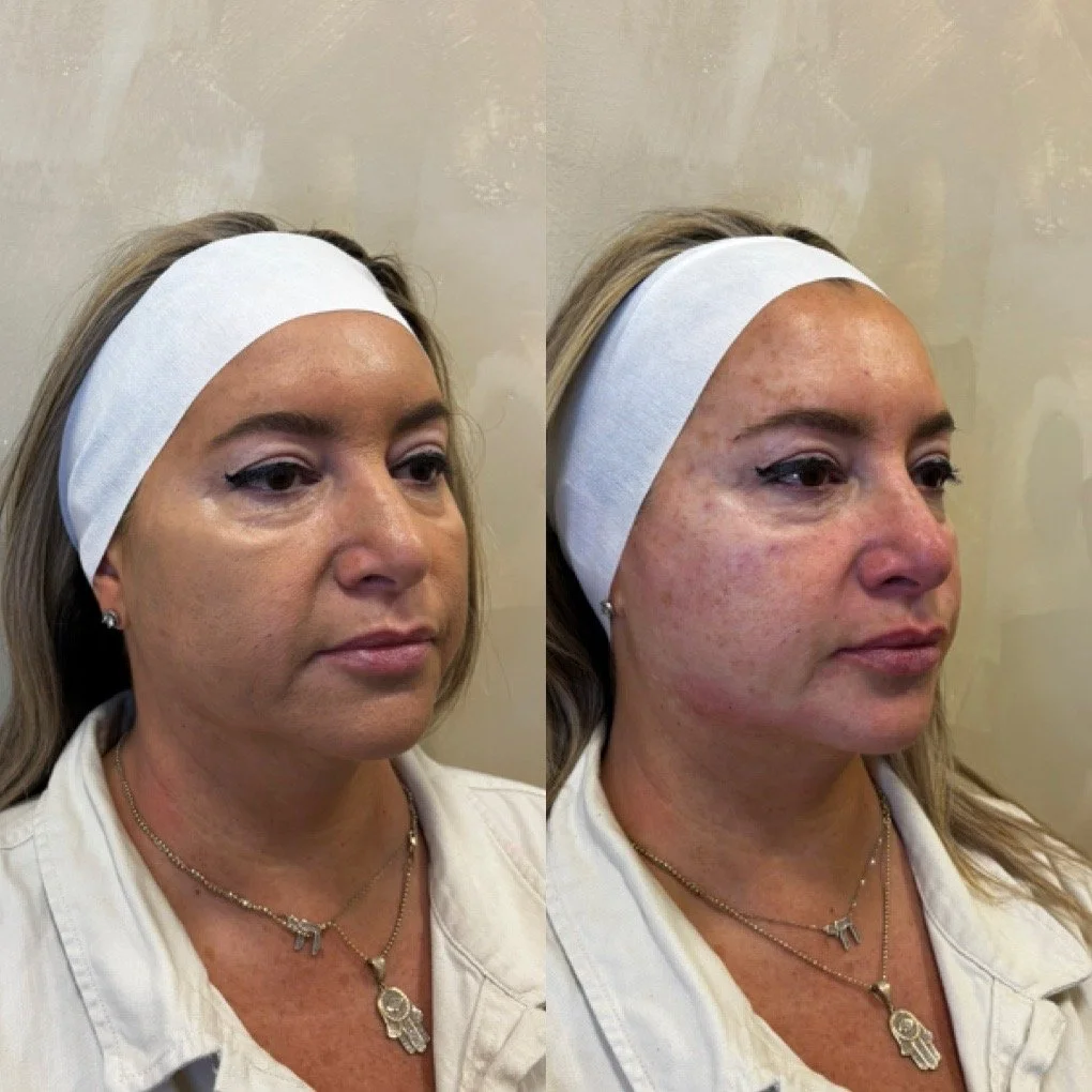 Full Face Filler before and after result