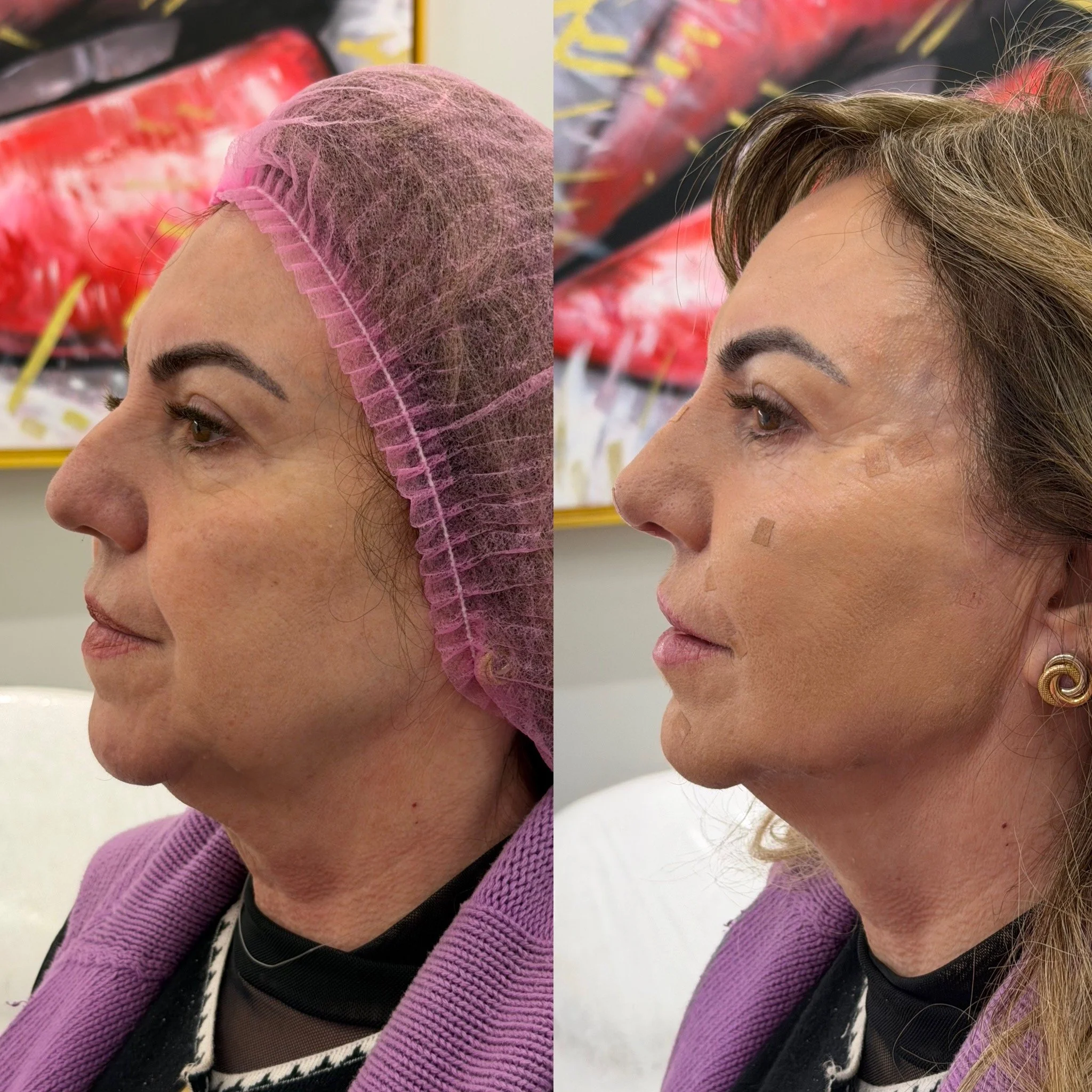 Full Face Filler before and after result