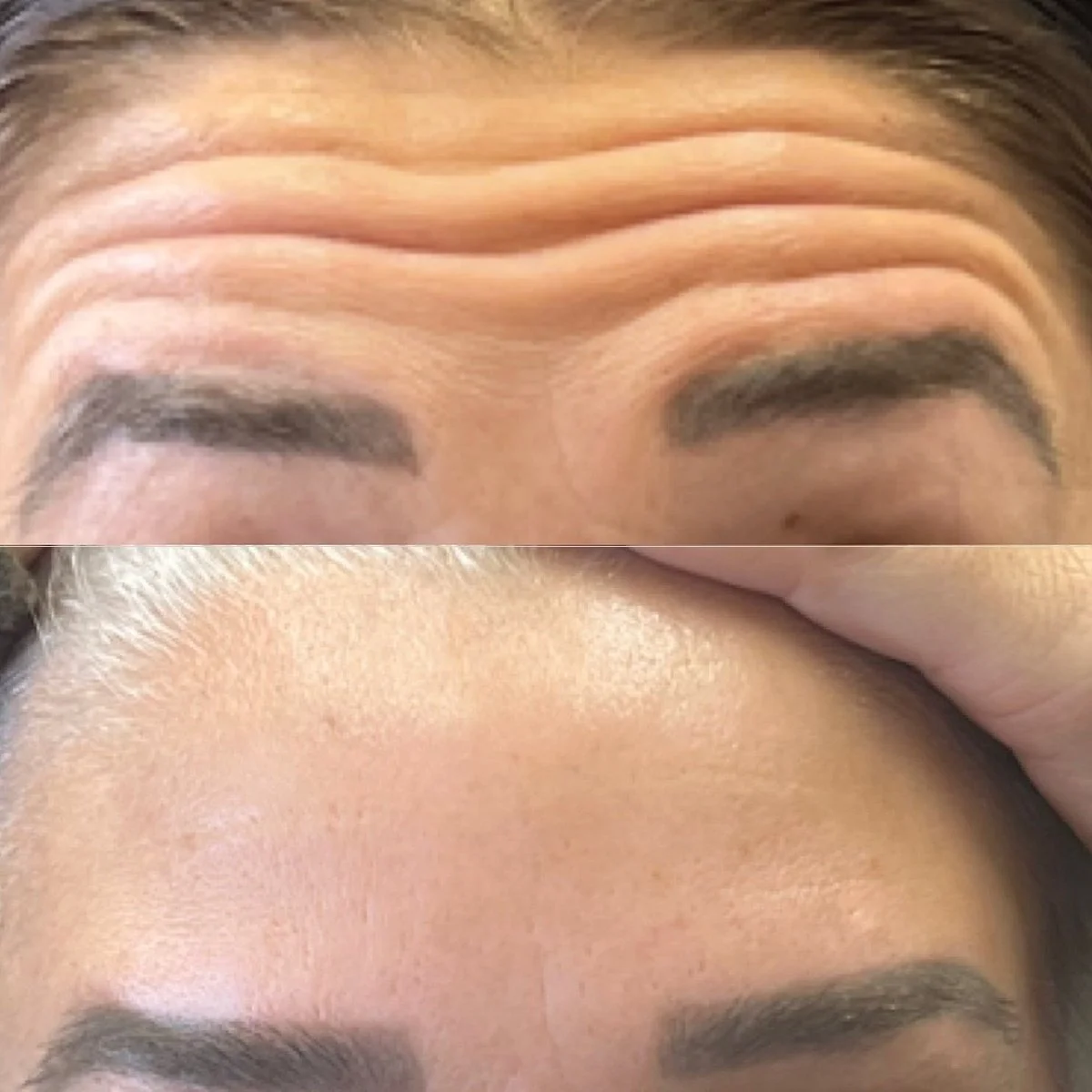 Botox before and after result