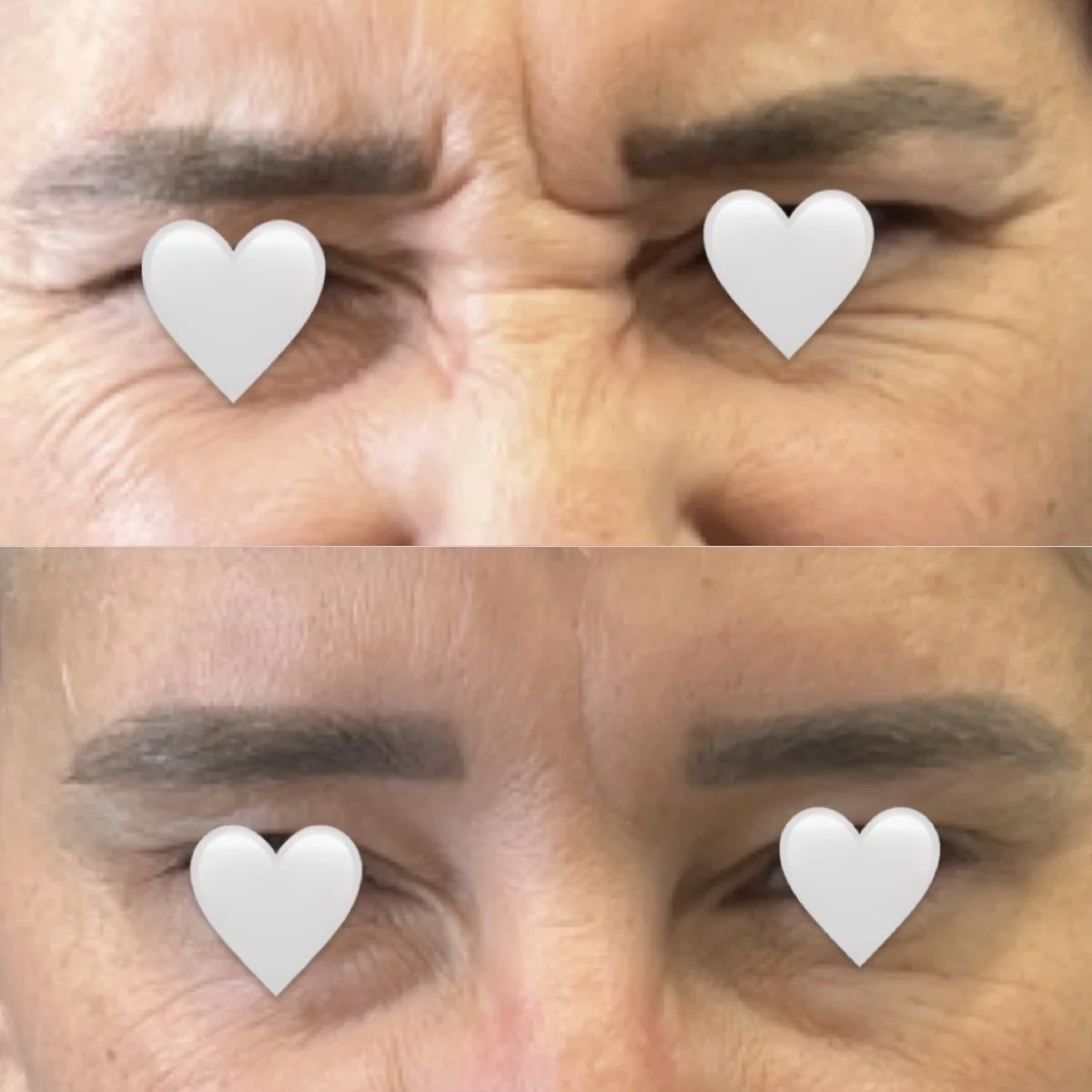 Botox before and after result